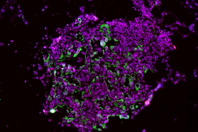 These lung tumor cells show high levels of the enzyme caspase-1 (green and red stains). This image was taken early in the…