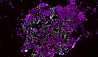 These lung tumor cells show high levels of the enzyme caspase-1 (green and red stains). This image was taken early in the…
