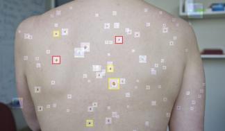 melanoma_story-720x479.jpg