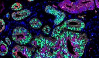 mit-cancer-states-01-press_0-720x480.jpg