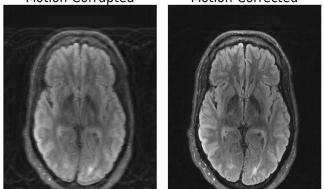 The image on the left depicts an MRI scan of the human brain corrupted by motion artifacts, whereas the image on the right…