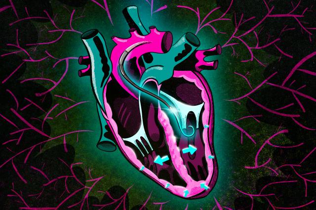 A new MIT study sheds light on how the heart responds to ventricle assist devices (VADs), which are often used to treat…