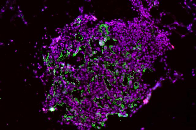These lung tumor cells show high levels of the enzyme caspase-1 (green and red stains). This image was taken early in the…