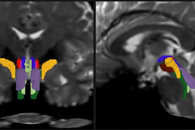 Researchers have developed a new way to resolve distinct bundles of nerve fibers in the brainstem. In this detail of a…